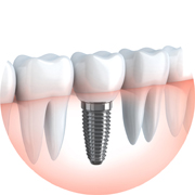 Implantología - Implantes dentales